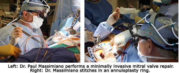 Dr. Paul Massimiano Performing A Mitral Valve Repair