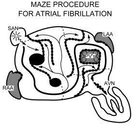 Diagram Of A Maze Procedure For Atrial Fibrillation