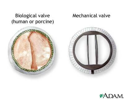 Pulmonary Valve Replacement Options - Tissue and Mechanical Valves