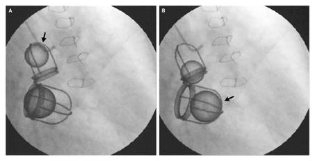 Ultrasound Images Of First Mechanical Heart Valve Replacement