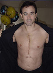 Broken Sternum Recovery - Patient Picture