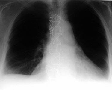 Median Sternotomy Xray With Wires