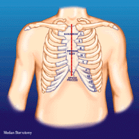 Sternotomy Incision Diagram