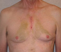 Chest With A Mini-Sternotomy Scar