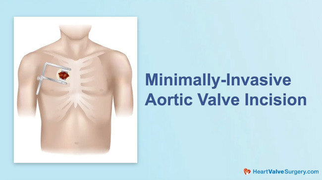 Minimally Invasive Aortic Valve Surgery Incision