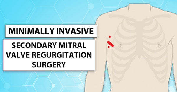 Minimally-Invasive Mitral Valve Surgery