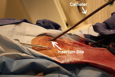 MitraClip Catheter Inserted
