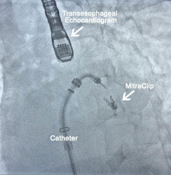 MitraClip Catheter Positioned Next To TEE