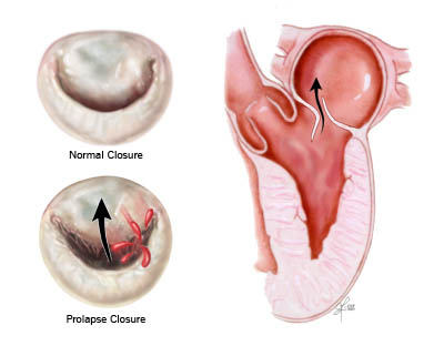 Mitral Valve Prolapse Anatomy