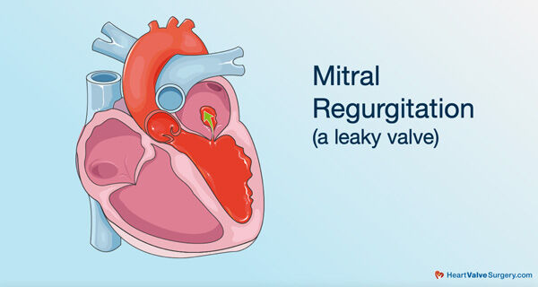 Mitral Regurgitation