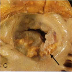 Calcified Mitral Valve Needing Mitral Valve Replacement