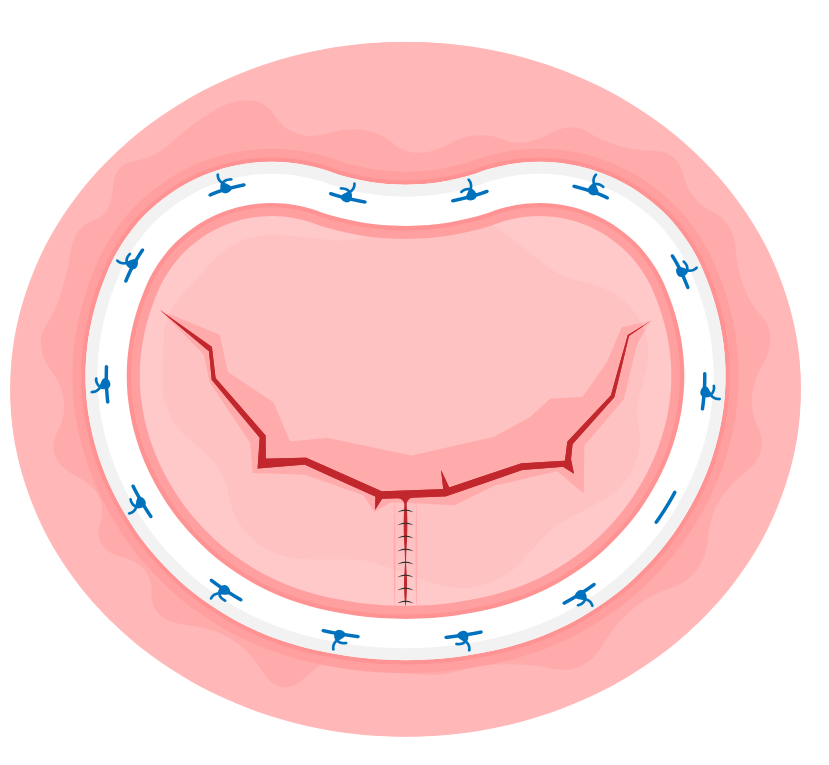 Mitral valve
