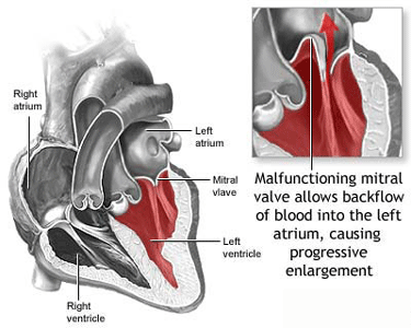 Drawing Of The Mitral Valve Prolapse Issues