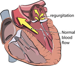 Mitral Valve Regurgitation