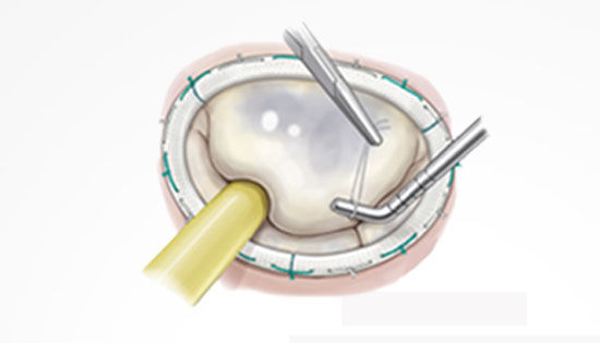 Mitral valve repair with surgical tools
