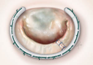 Mitral Regurgitation Repair Using Annuloplasty Ring