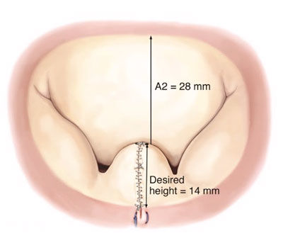 Surgical Diagram of a Mitral Valve Repair