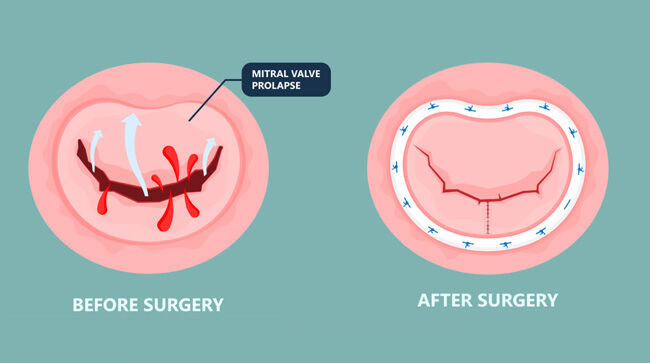 Mitral Valve Repair: Before & After Resection & Annuloplasty Ring