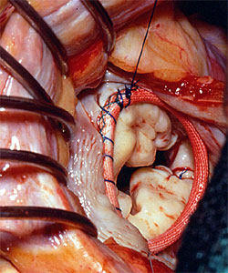 Annuloplasty Ring Implanted During Mitral Valve Repair Surgery