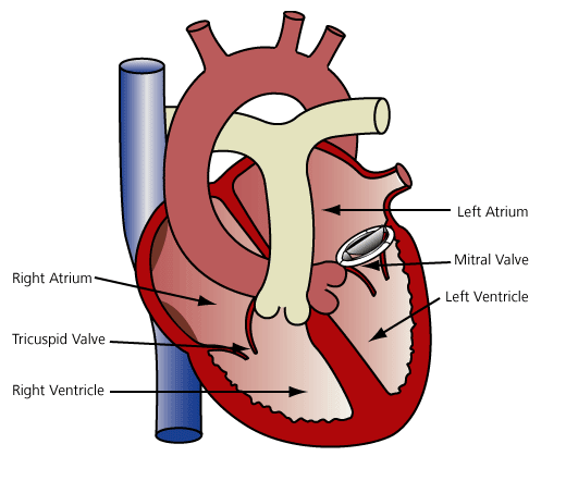 Diagram Of Mitral Valve Replacement In Place