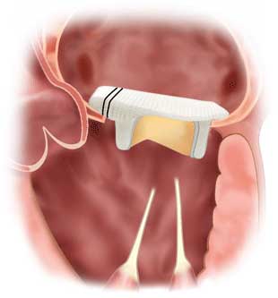 Tissue mitral valve replacement implanted in heart