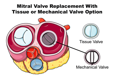 Tissue and Mechanical Valve Options for Mitral Valve Replacement Surgery