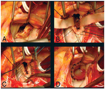 Mitral Valve Replacement With Bovine (Cow) Valve