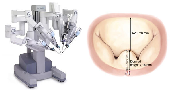 DaVinci Surgical Robot next to diseased mitral valve that has been repaired