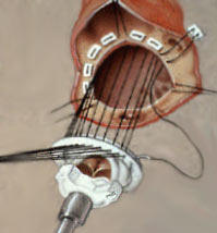 Valve Replacement Being Sutured Into Heart - Diagram