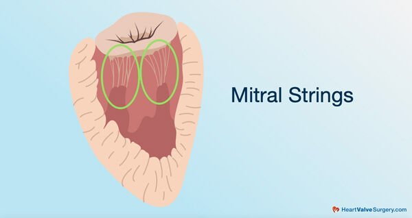 Mitral Valve Strings (Chords)