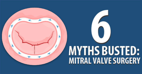 Mitral Valve Surgery Myths Debunked