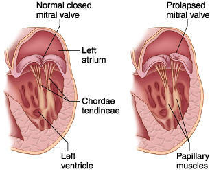 Normal & Prolapsed Mitral Valve Showing Mitral Chordae