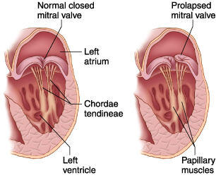 Mitral Valve Prolapse Chordae