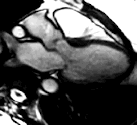 MRI Human Heart Valves
