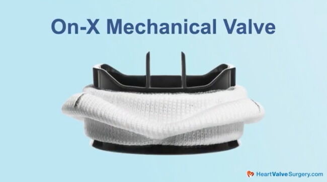 On-X Mechanical Heart Valve Replacement