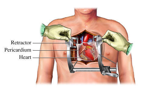 Open Heart Surgery Illustration