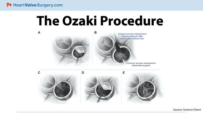 Ozaki Procedure Diagram