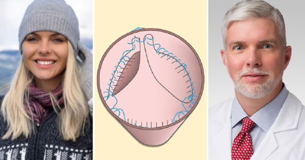 Ozaki Procedure Research for Aortic Valve Patients with Dr. Johnston