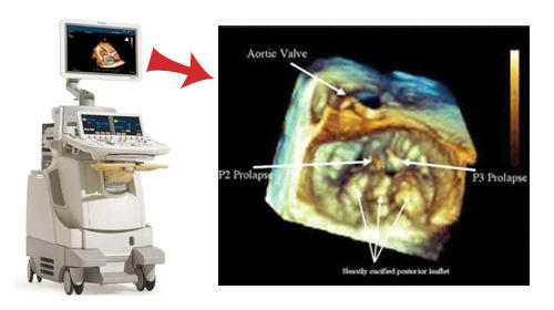 3d Pictures Of Heart Valves