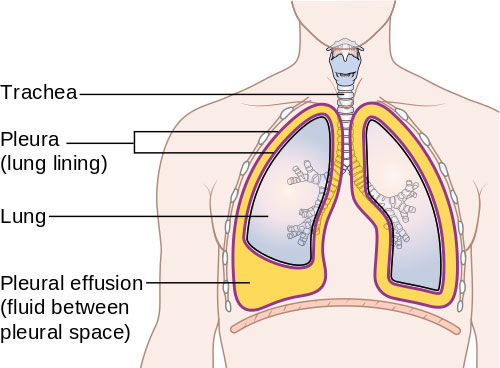 Pleural Effusion After Heart Surgery