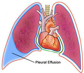 Pleural Effusion After Open Heart Surgery