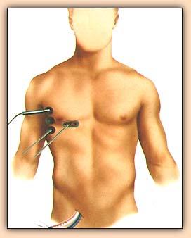 Port Access Surgery Diagram For Valve Replacement