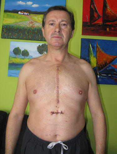 Filomeno Faustino - Aortic Valve Replacement Patient In Portugal