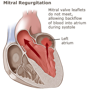 Diagram Of Mitral Valve Showing Leakage Across The Valve