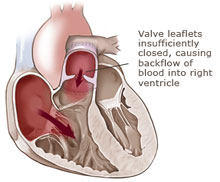 Pulmonary Regurgitation Diagram Showing Leaking Blood