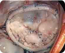 Pulmonary Valve Repair with Annuloplasty Ring