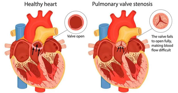 Pulmonary Valve Stenosis
