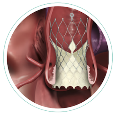 Medtronic TAVR