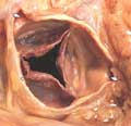 Picture Of A Rare Quadricuspid Heart Valve