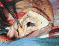 Quadricuspid Heart Valve Image